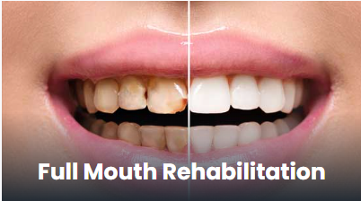 Full mouth rehabilitation in Pune