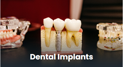 Dental implants in Punawale, Pune