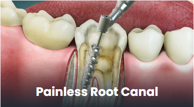Painless root canal treatment in Punawale, Pune