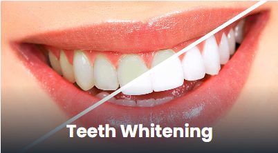 Teeth whitening clinic in Punawale, Pune