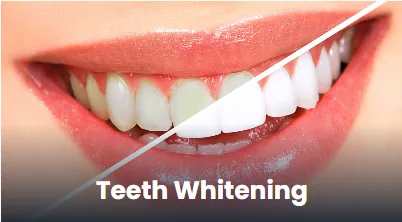 Teeth whitening clinic in Punawale, Pune