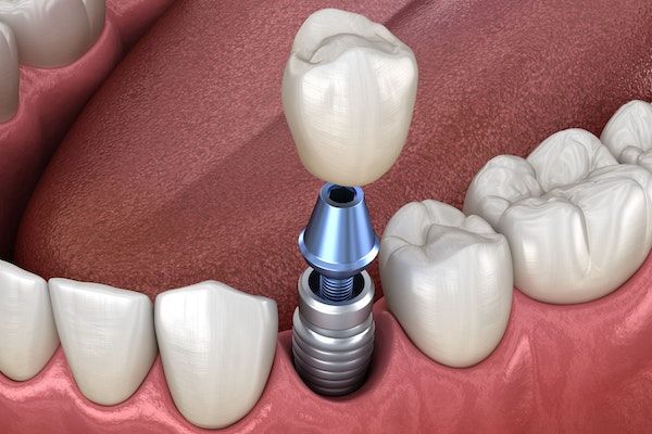 Dental implant with an abutment and artificial crown shown between natural teeth, illustrating tooth replacement treatment.