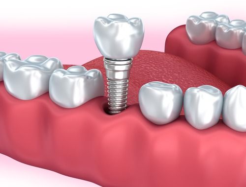 Dental implant procedure for tooth replacement in Pune by Dr. Hileri Mori