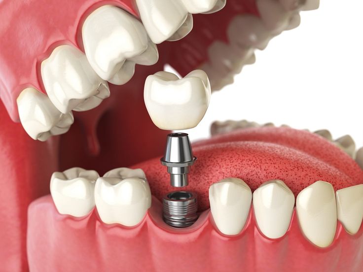 Dental implant components shown with an artificial crown and abutment positioned above a dental implant between natural teeth.